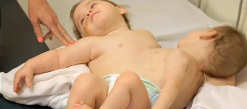 Conjoined twins who faced each other separated in California surgery