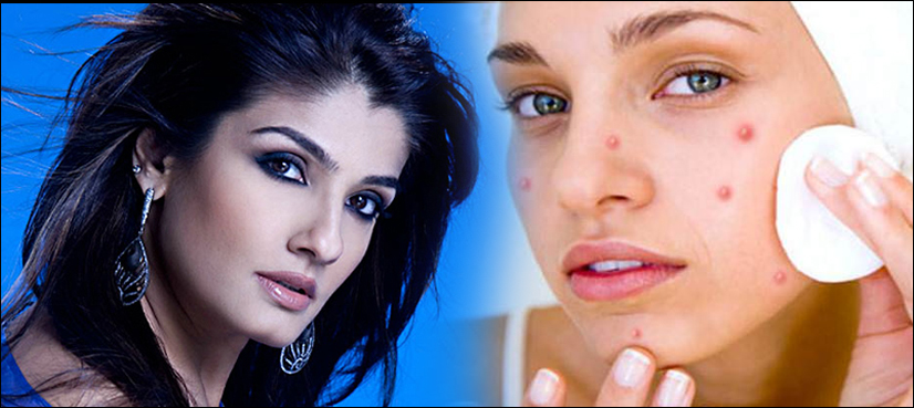 WATCH: Raveena Tandon has some tips for your acne problem