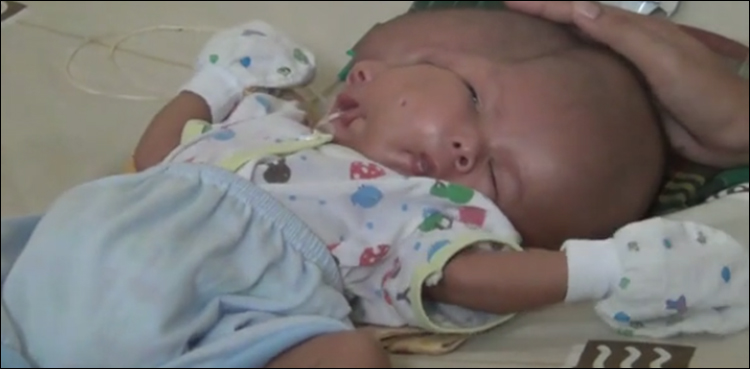 Baby born with two faces and two brains after conjoined twin failed to develop