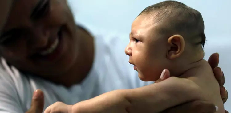 Zika in Africa: Rare birth defect on the rise in Angola