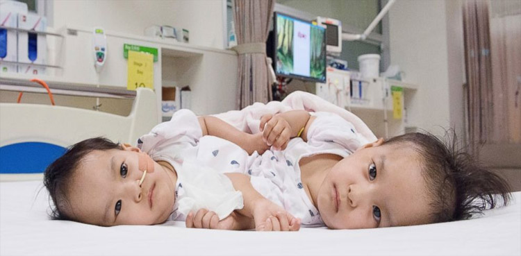 Rawalpindi doctors successfully separate conjoined twins
