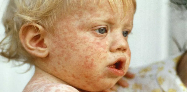Second US child dies of measles, almost 650 ill: officials