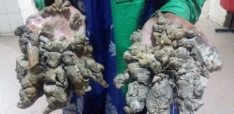 Tree Man' dreams of cure as rare skin disease returns