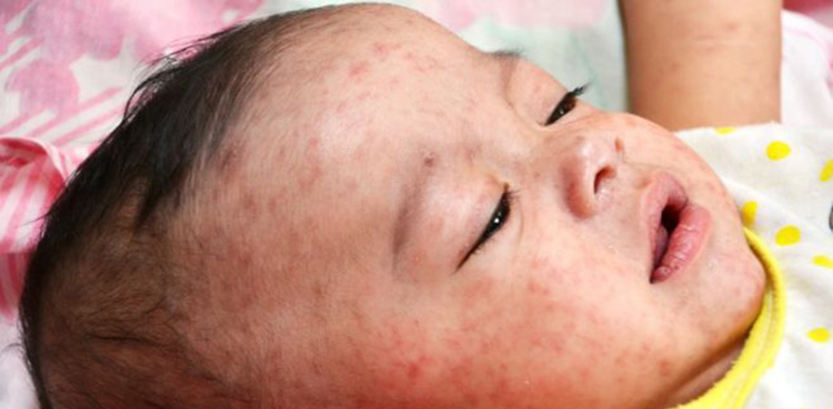 Three children die of measles in Sanghar