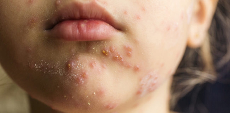 Three children die of measles in Kashmore