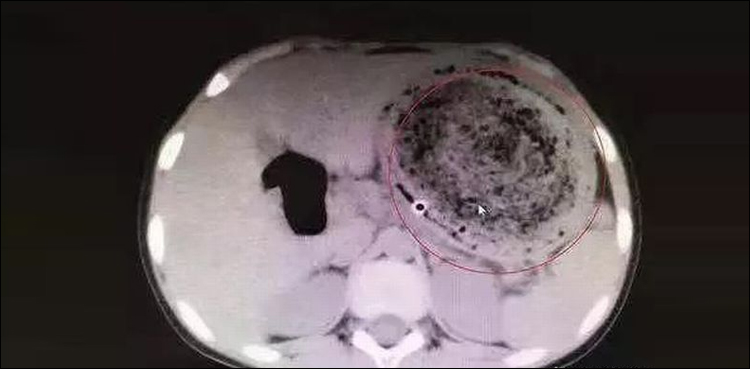 Doctors find 1.5kg hairball in Chinese girl’s stomach