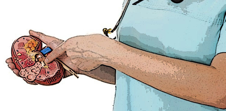 A new treatment for kidney stones