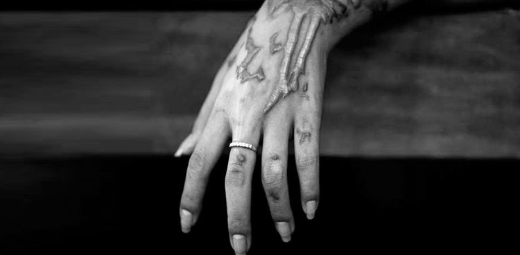 Girl attacked with acid in Daska after marriage proposal refused