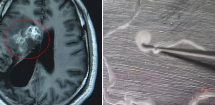 Tapeworm eating man's brain for 15 years removed