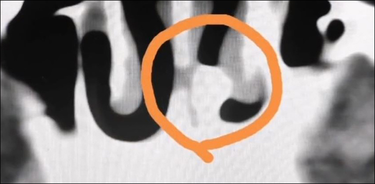 WATCH: Man's nostril gets blocked by own tooth