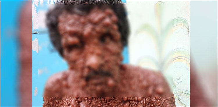 India's 'bubble man' carrying several tumors desperate to get treatment