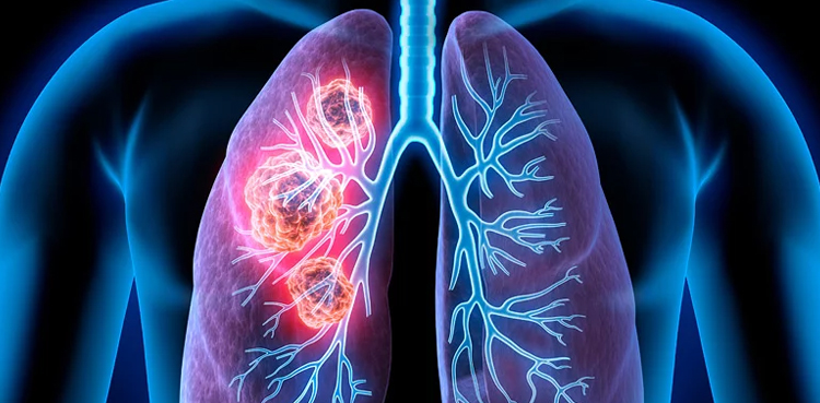 Strides in lung cancer lead steep decline in cancer deaths