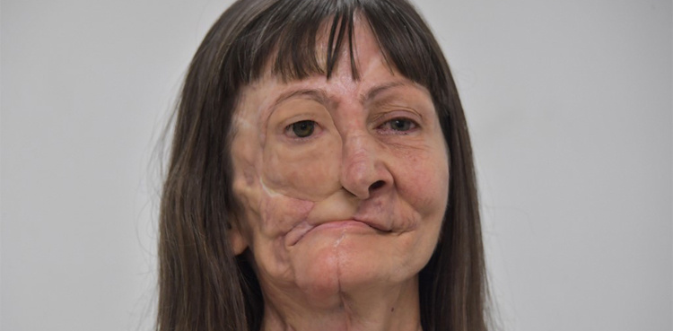 Prosthesis gives cancer survivor a new face