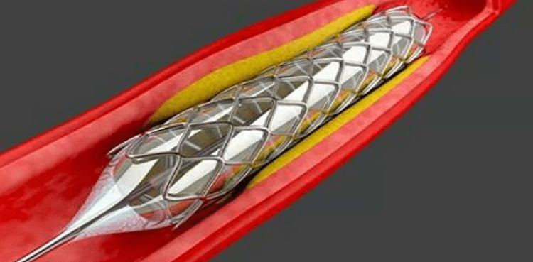 PIC stent case: LHC orders action against responsible