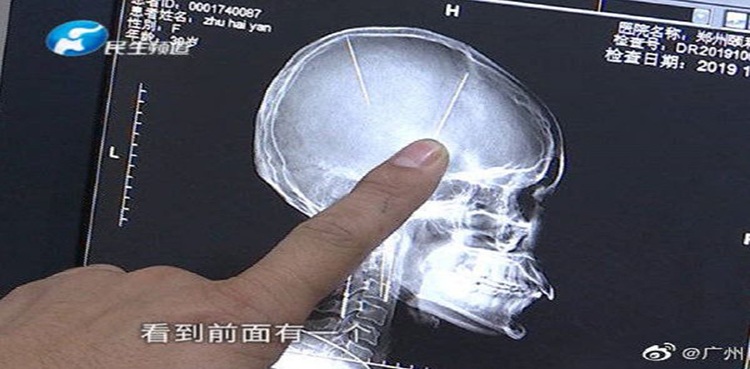 Shocking! Woman astounded to find 2 needles inside her brain