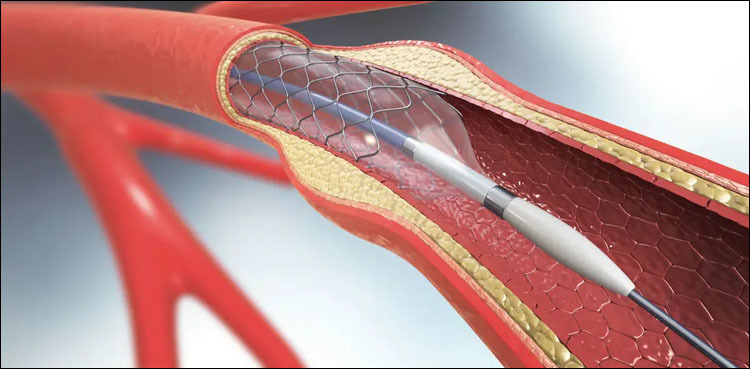 Pakistan becomes 18th country globally to produce cardiac stents