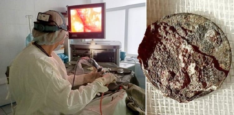 Coin removed from man’s nose after being stuck for more than 50 years