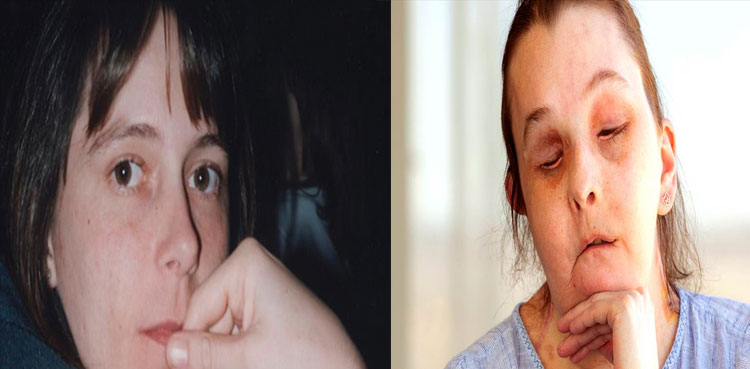 Domestic abuse survivor becomes 1st person ever to undergo second face transplant