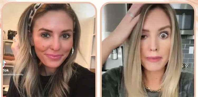 Blogger left with drooping eyelid after Botox experience goes wrong