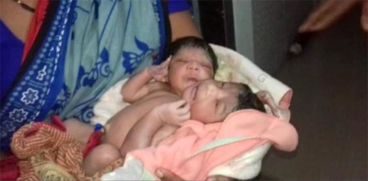 Woman gives birth to conjoined twins with two heads, three arms