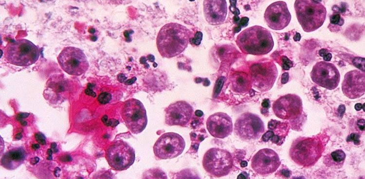 Naegleria claims two more lives in Karachi