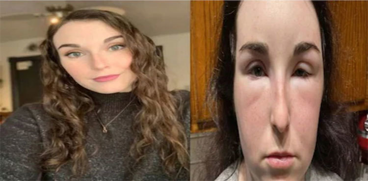 Woman ends up in hospital as hair dye causes severe allergic reaction