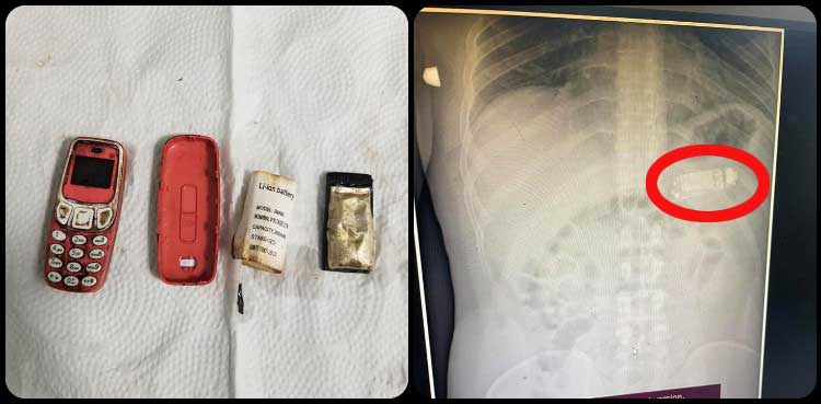 Man swallows mobile phone, undergoes successful surgery for removal