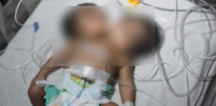 Mother flees hospital after giving birth to two-headed baby