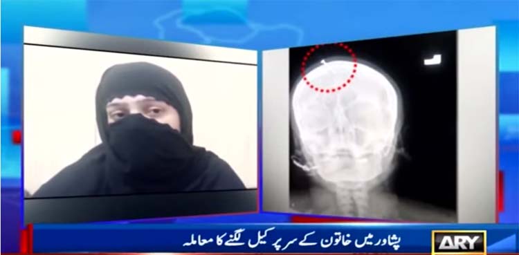 Hammered nail: Pregnant woman retracts remarks, blames doctor