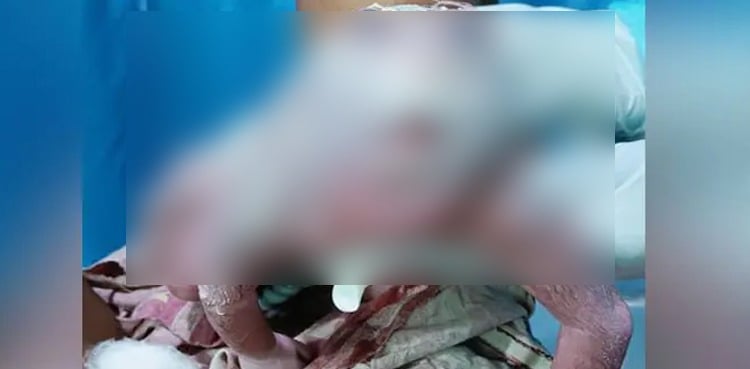 PHOTO: Frog-faced baby goes viral