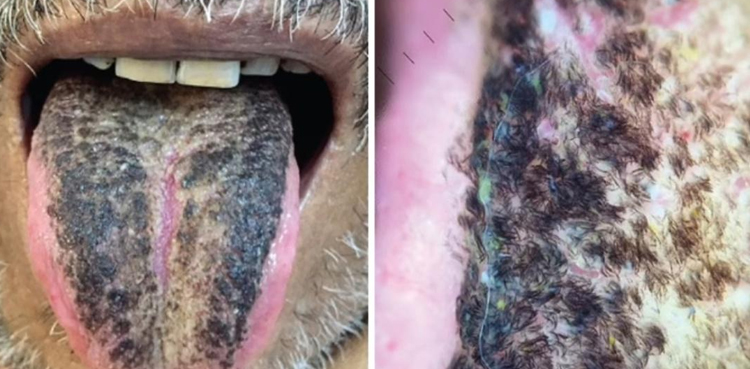 Man ends up with Black And 'Hairy' tongue after following special diet