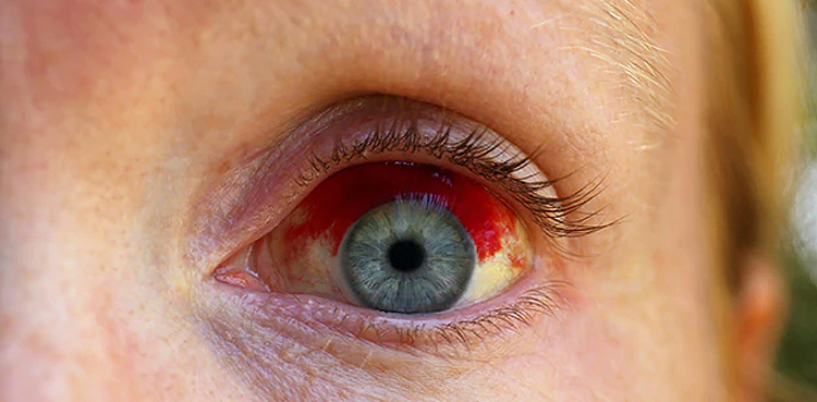 COVID-19 may increase risk for rare eye clots