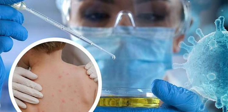 Monkeypox outbreak in Europe 'largest ever' in region