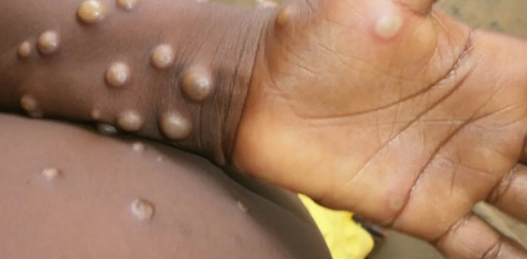 Monkeypox: a rare disease with low fatality rates