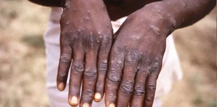 Patel chairs session over monkeypox disease after WHO alert