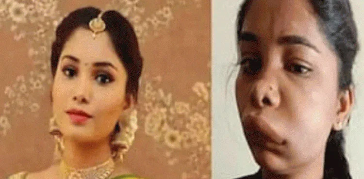 Indian actor gets swollen face after botched surgery; photos go viral