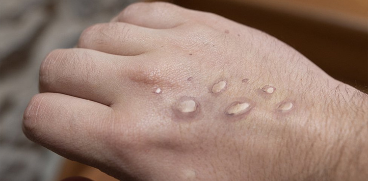 Karachi reports three more suspected monkeypox cases