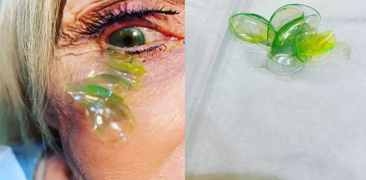Viral video: Doctor removes 23 contact lenses from woman’s eye
