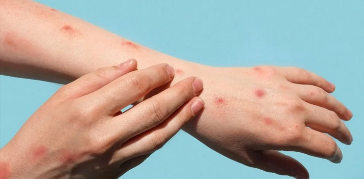 China discovers cluster of new mpox strain