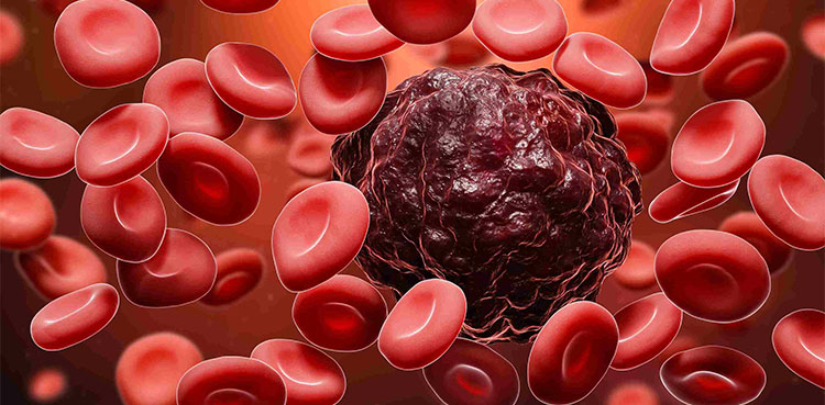 Imetelstat: Blood cancer drug succeeds in late-stage study