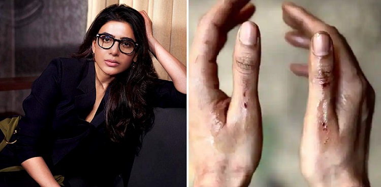 Perks of action: Samantha flaunts her bruises from 'Citadel' set