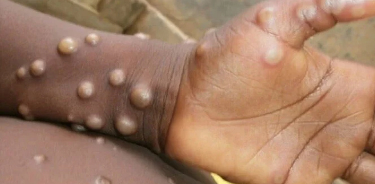 Monkeypox cases detected in Pakistan, special guidelines issued