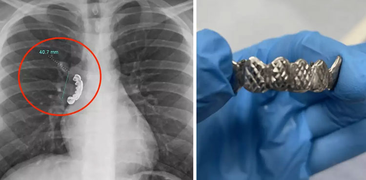 Man gets dentures stuck in lung after swallowing by accident
