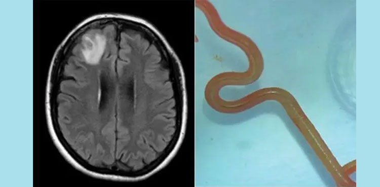 In a world-first, 8-cm parasite plucked from woman's brain