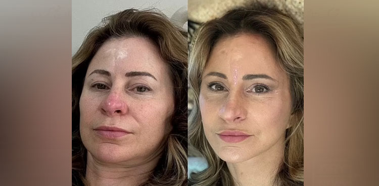 Woman sells house to pay for facelift surgery