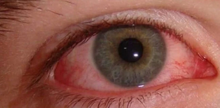 85 new cases of Pink Eye infection reported in Lahore