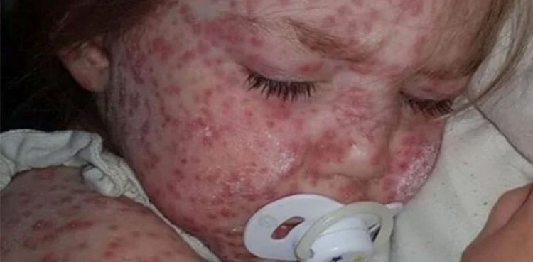 KP hospitals on high alert amid rising chicken pox cases