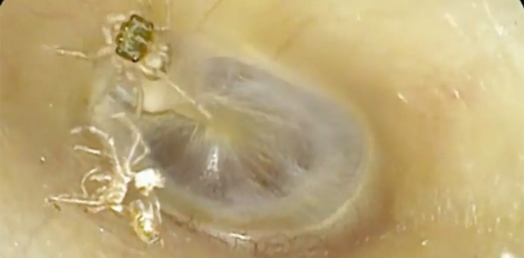 Watch: Woman Complained Of ''Abnormal Sounds'' Finds Spider In Her Ear