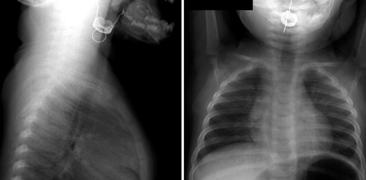 Nurse warns parents after toddler accidentally swallows Christmas ornament