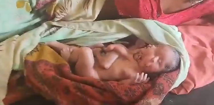 Woman gives birth to baby with four legs, four arms, two faces
